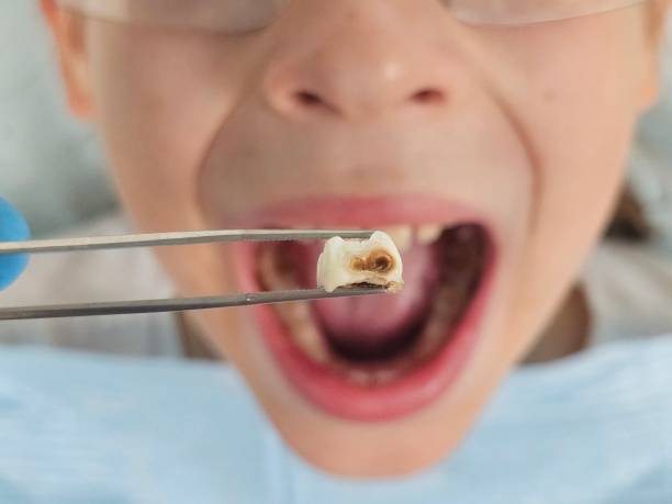 Best Emergency Root Canal Treatment in Pierre Part, LA